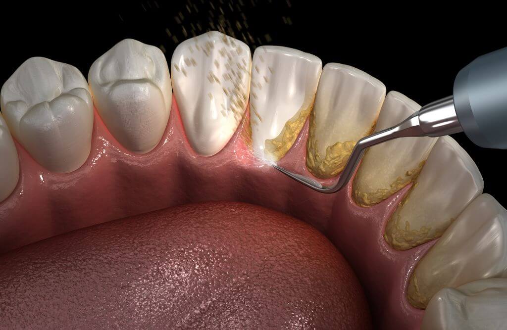 The Difference Of Dental Deep Cleaning vs Regular Cleaning Smiles By
